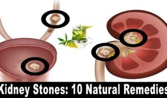 kidney-stones-10-natural-remedies-6823230