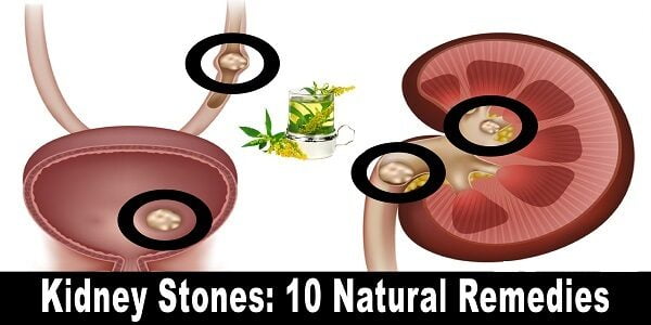 kidney-stones-10-natural-remedies-6823230